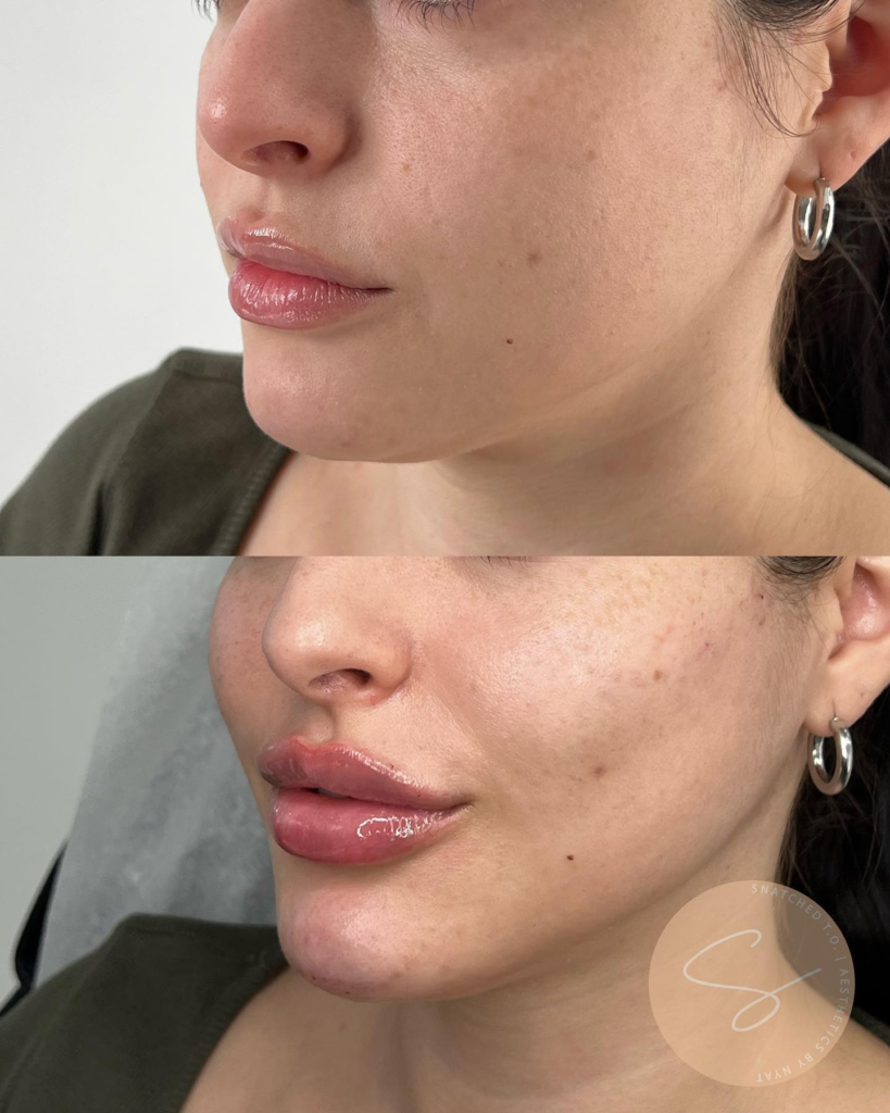 lip-filler-toronto-blog